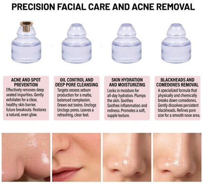 Blackhead Remover Vacuum – 5 Suction Levels & 4 Probes
