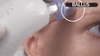 Blackhead Remover Vacuum – 5 Suction Levels & 4 Probes